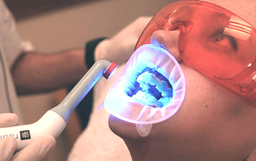 Laser tooth whitening