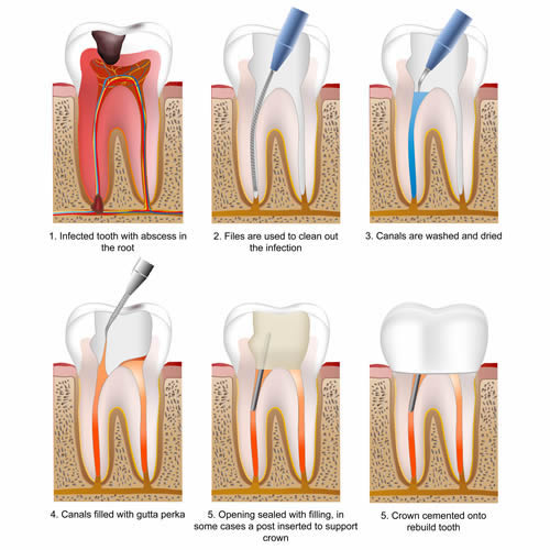 root-canal treatment