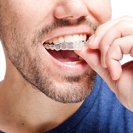 Wearing Invisalign Aligners