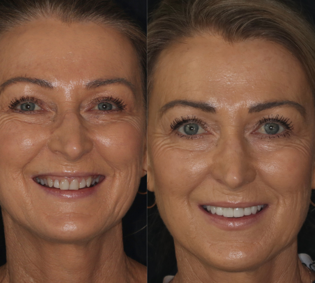 before and after veneers 4