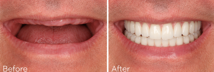 Implant-supported denture before and after, Solihull