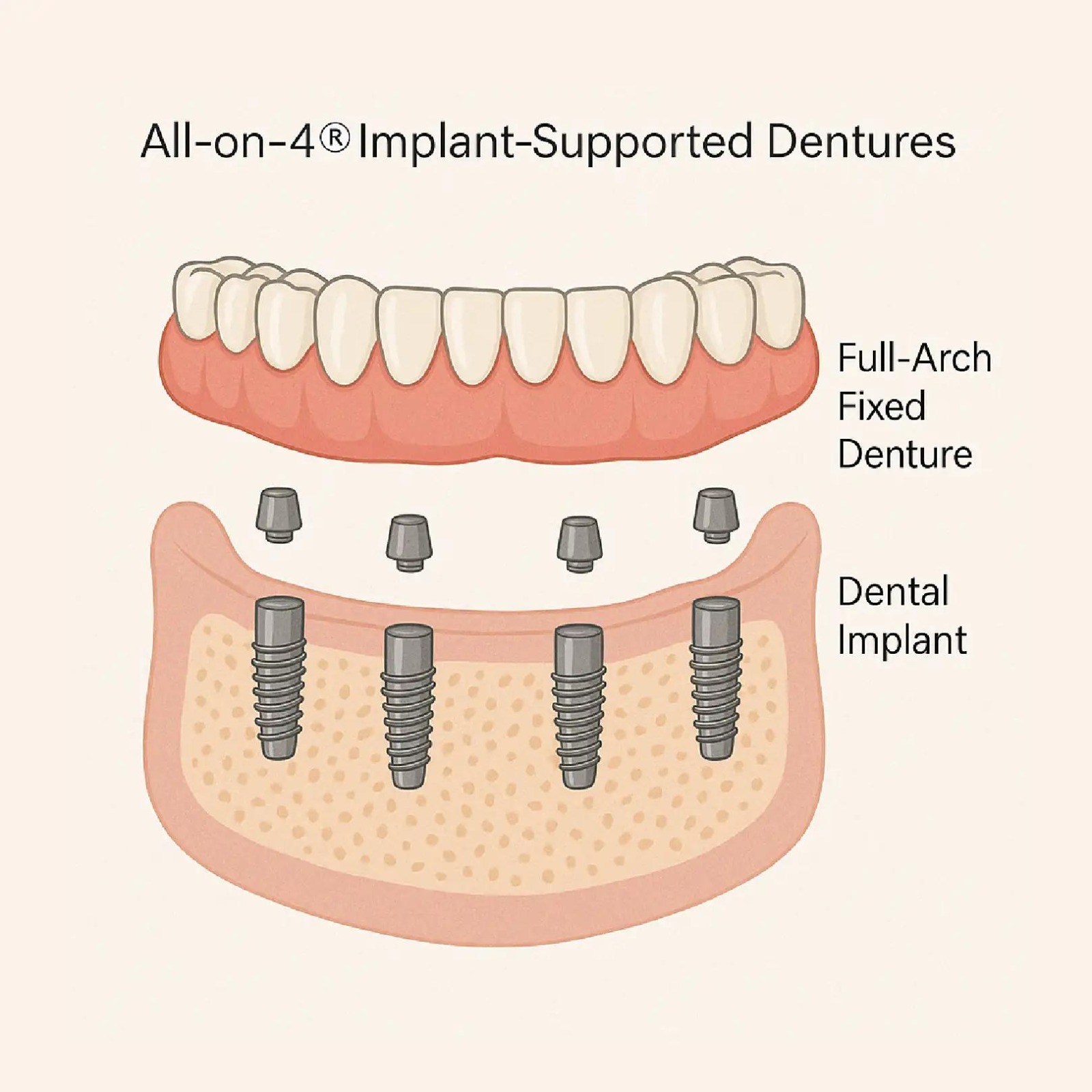 Illustration of a full arch of teeth supported by dental implants