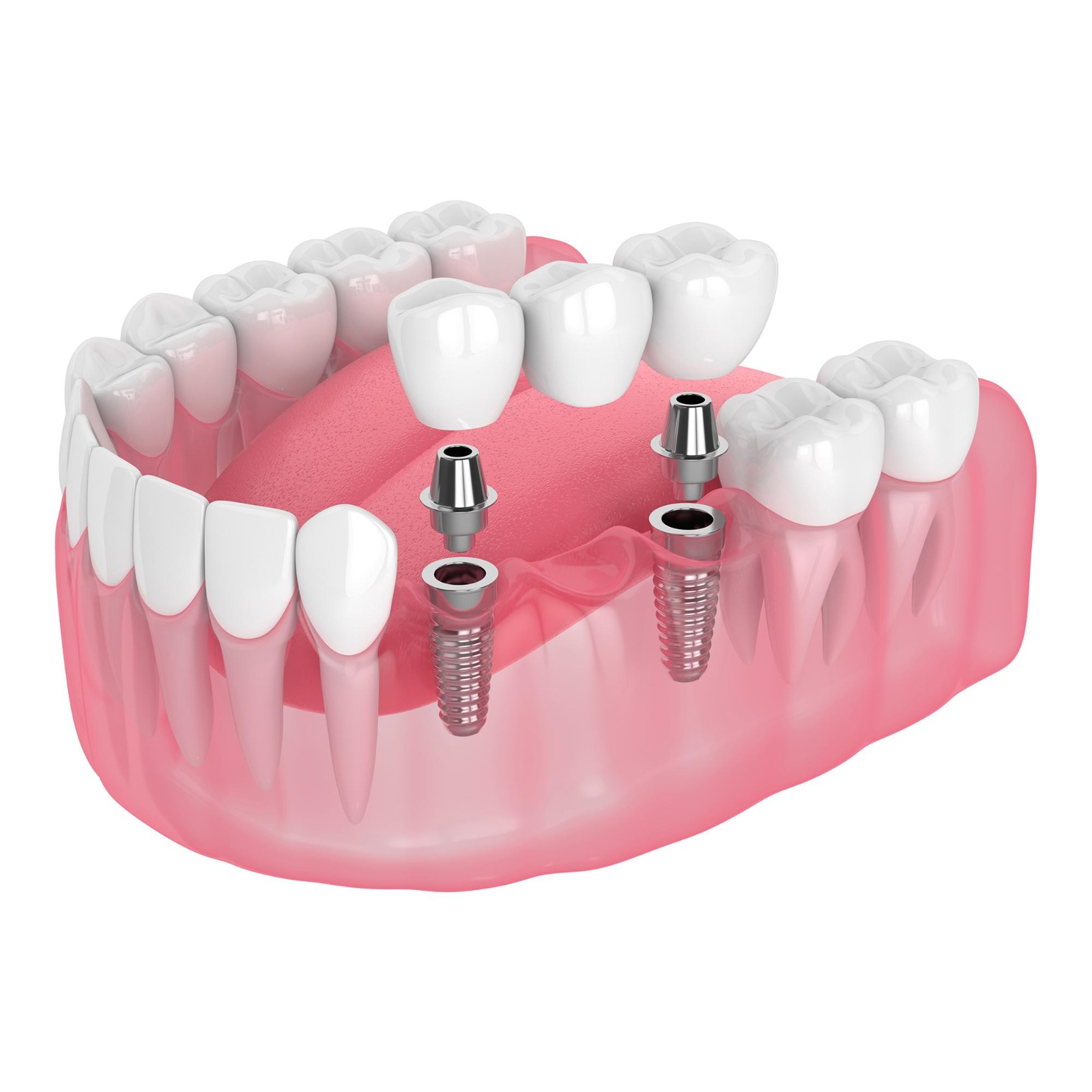 Illustration of an implant-supported bridge replacing several teeth