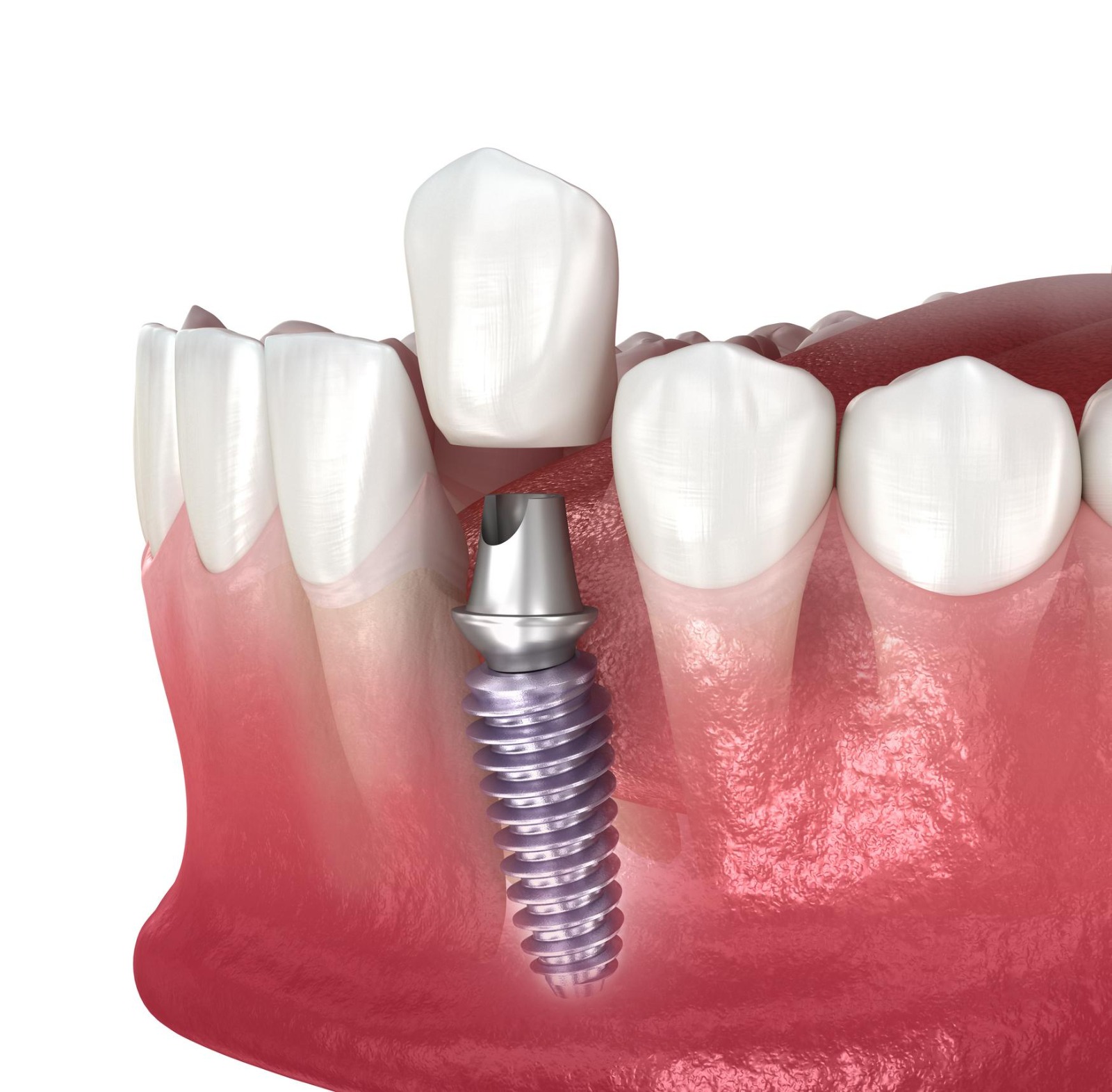 Illustration of a single dental implant and crown